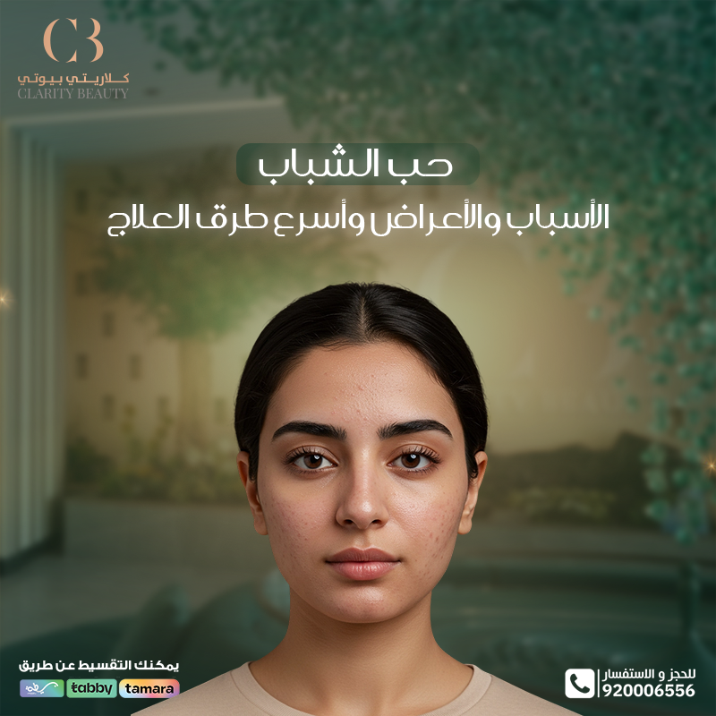 حب الشباب: الأسباب والأعراض وأسرع طرق العلاج