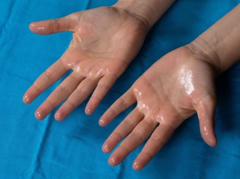 كيف تتخلص من فرط التعرق بدون جراحة؟